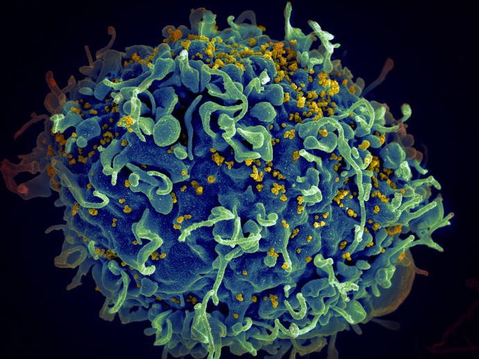 HIV causes a five-year acceleration in the aging process