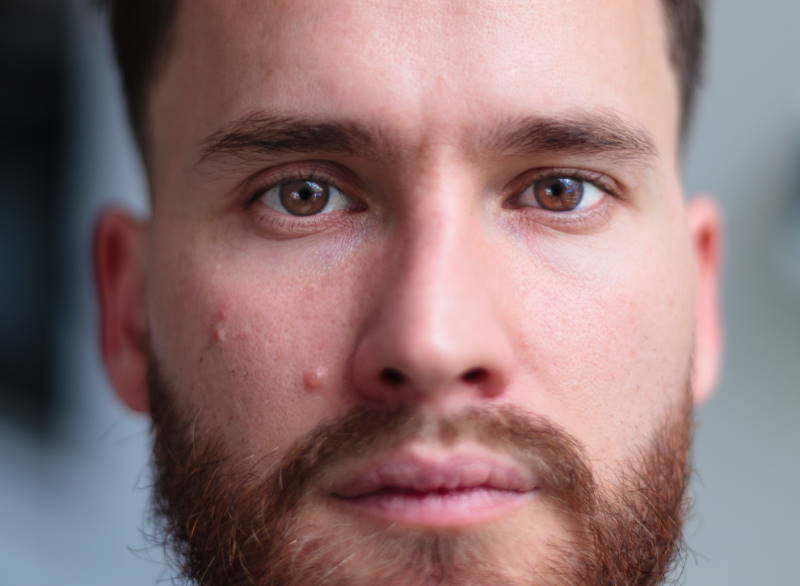 Why do humans love popping pimples?